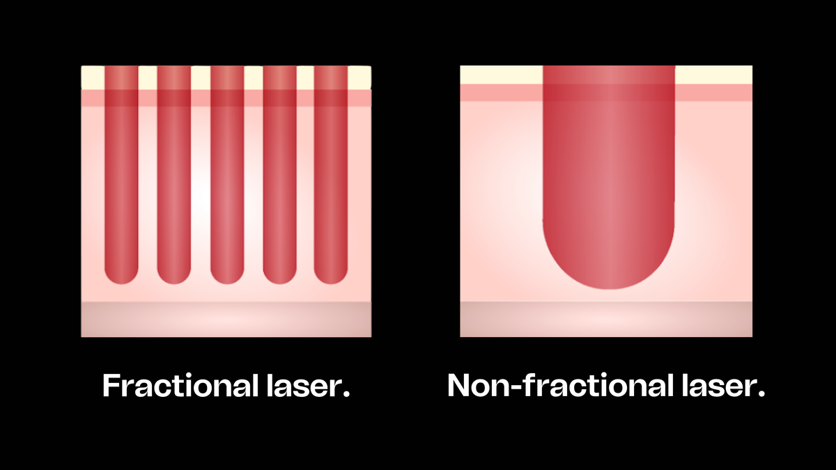 Fractional laser vs non-fractional laser skin diagram.