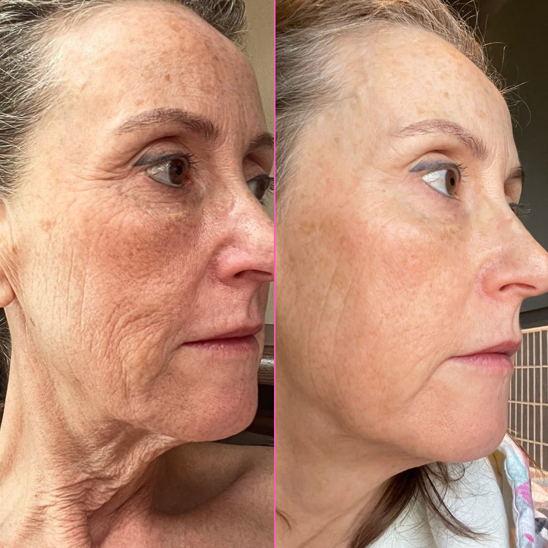 Side-by-side comparison of a woman's face with and without visible aging effects.